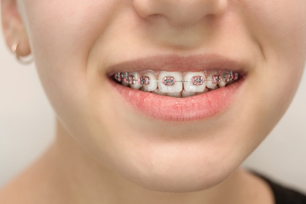 How Braces Affect Dental Cleanings